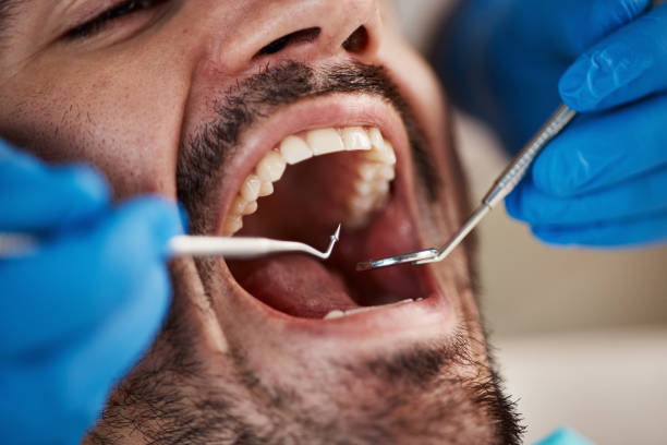 Best Emergency Wisdom Teeth Removal in Mcdade, TX