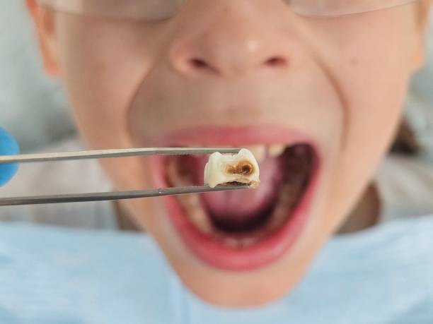Best Emergency Treatment for Toothache in Mcdade, TX